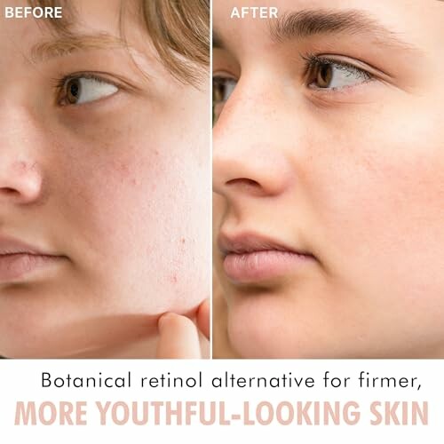 Comparison of skin before and after using botanical retinol alternative.